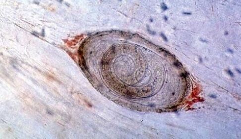 Trichinella