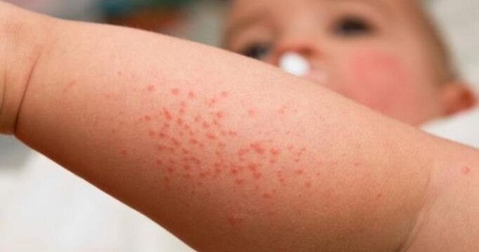 erupção cutânea como sintoma de infecção parasitária